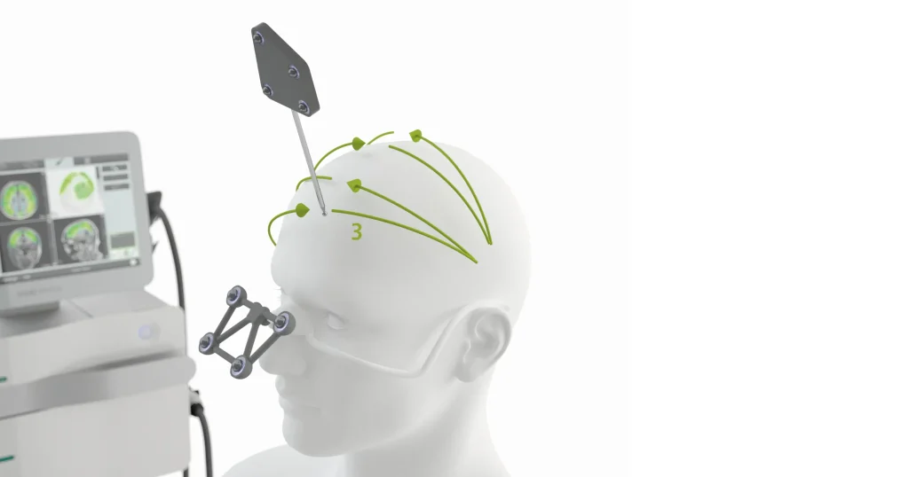 Shema TPS terapije: naprava Neurolith izvaja transkranialno pulzno stimulacijo možganov s pomočjo usmerjenih akustičnih impulzov.