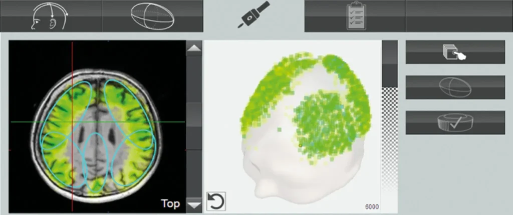 Zaslon z MRI posnetki in 3D modelom glave, ki prikazuje ciljna področja možganov za transkranialno pulzno stimulacijo (TPS) z napravo Neurolith