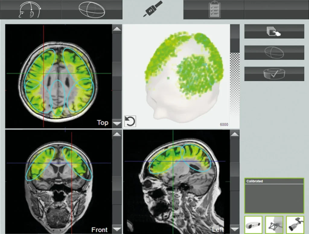 MRI posnetek možganov z označenimi regijami za TPS terapijo pri rehabilitaciji po možganski kapi