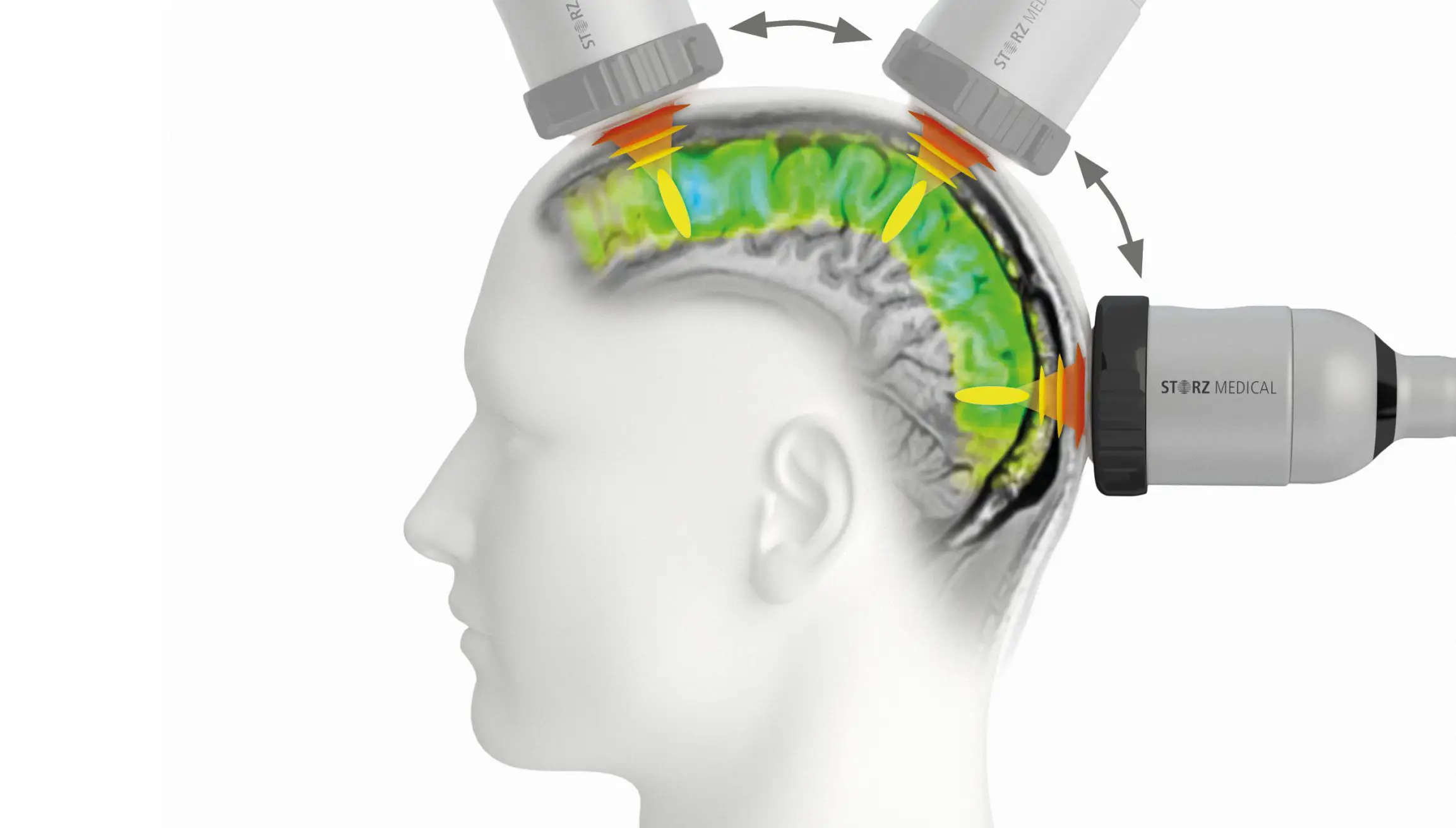 TPS terapija možganov z napravo Storz Medical za rehabilitacijo po možganski kapi